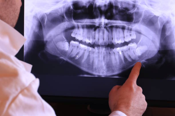 Best Emergency Wisdom Teeth Removal in Oceanside, CA