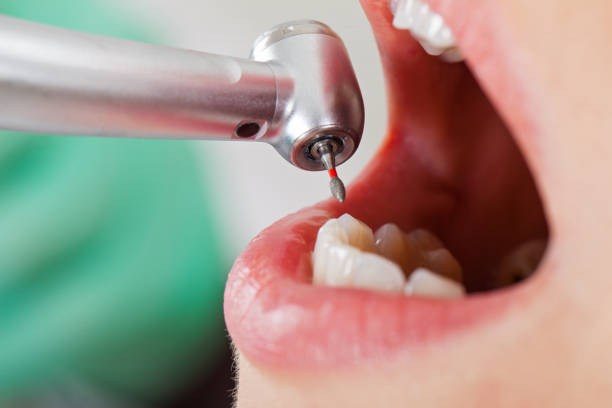 Best Emergency Broken Tooth Repair in Oceanside, CA